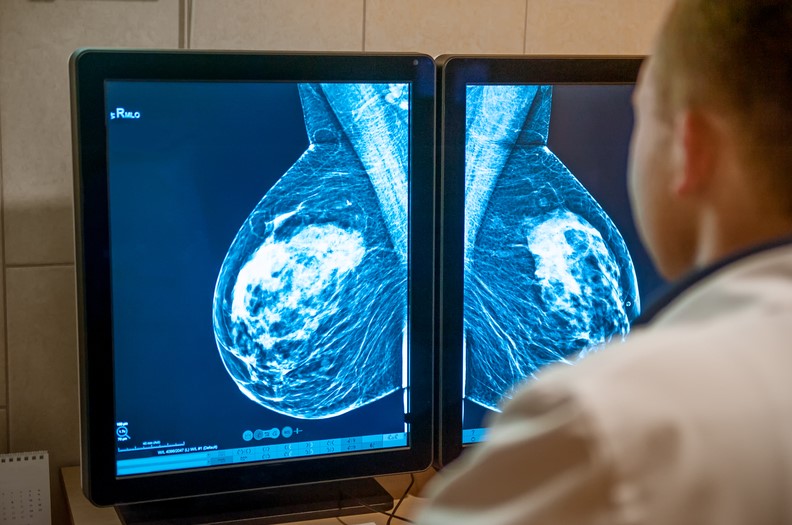 Un test genetic revoluționar poate oferi milioanelor de paciente cu cancer de sân șansa de a evita chimioterapia